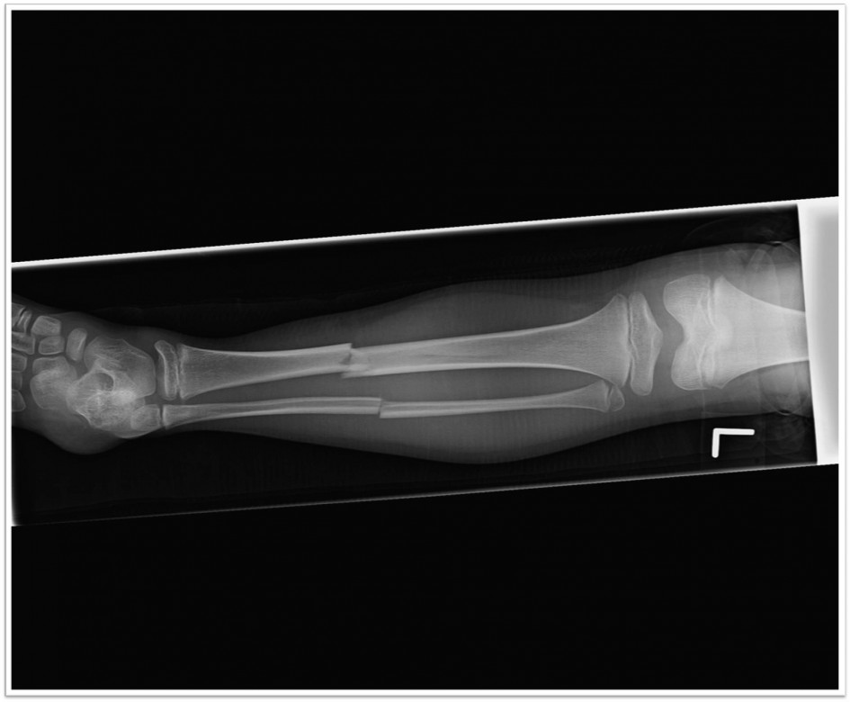 Kylie-boot-fracture